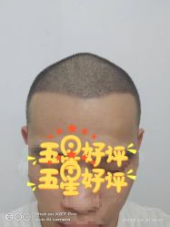 点击看大图 体验后-大麦微针植发全国连锁
