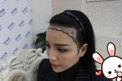 -大麦微针植发丨全国连锁