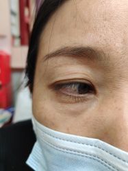 -北京美痣堂古方祛痣斑疣瘊