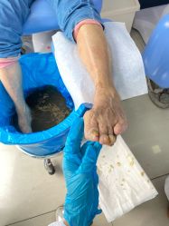 -德哥灰指甲脚气甲沟炎跖疣护理