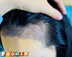 -大麦微针植发丨全国连锁