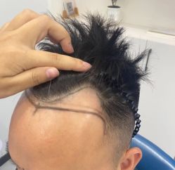 -大麦微针植发全国连锁