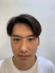 体验后-郡艺医疗美容·微整·眼鼻吸脂