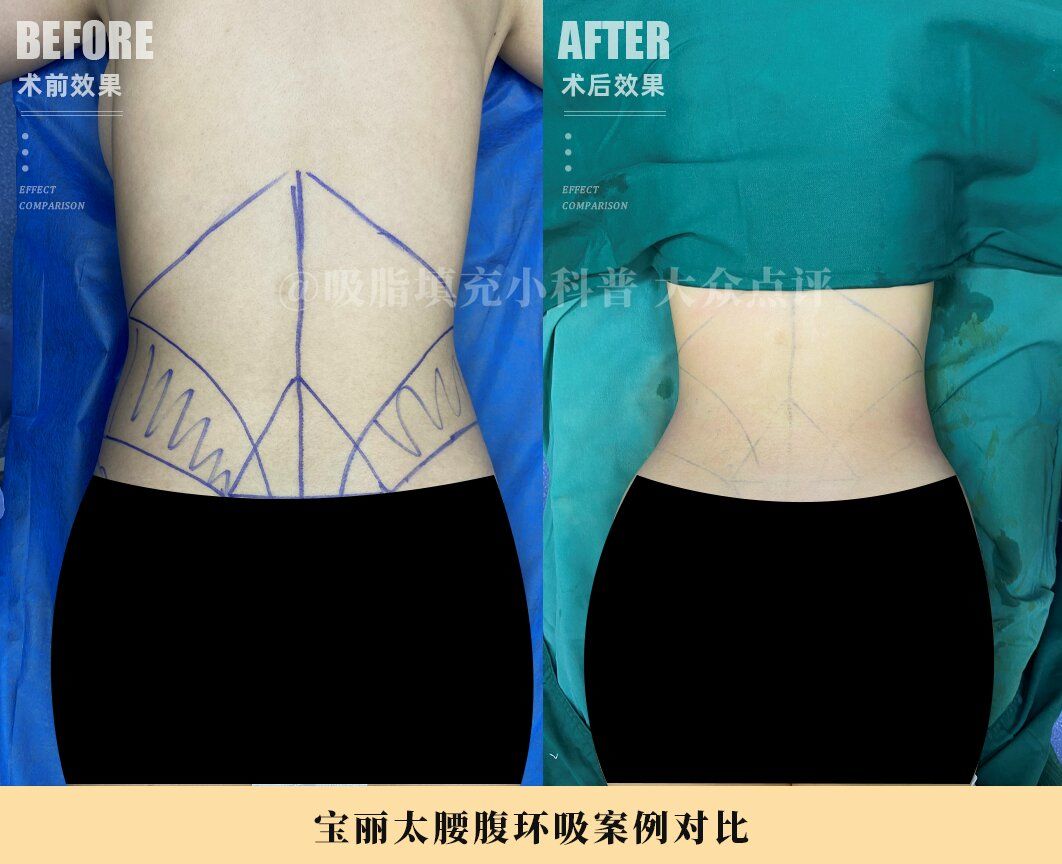 腰腹环吸配合黄金微雕术后即刻对比