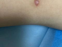 -杭州仁易堂中医康复医院疤痕修复