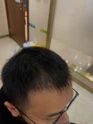 -碧莲盛·不剃发植发