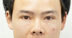 -天津健丽·去眼袋医疗美容机构