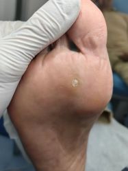 -德哥灰指甲脚气甲沟炎跖疣护理