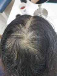 -大麦微针植发丨全国连锁