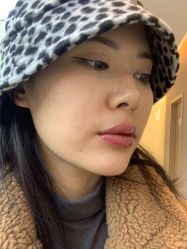 体验后-More摩尔医美の注射线雕光电中心