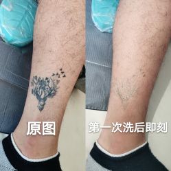 -秦好山专业洗纹身