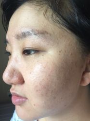 -美丽人生祛斑扁平疣汗管瘤中心