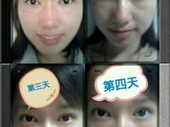 术后四天-上海华安整形外科门诊部