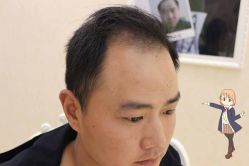 -大麦微针植发丨全国连锁