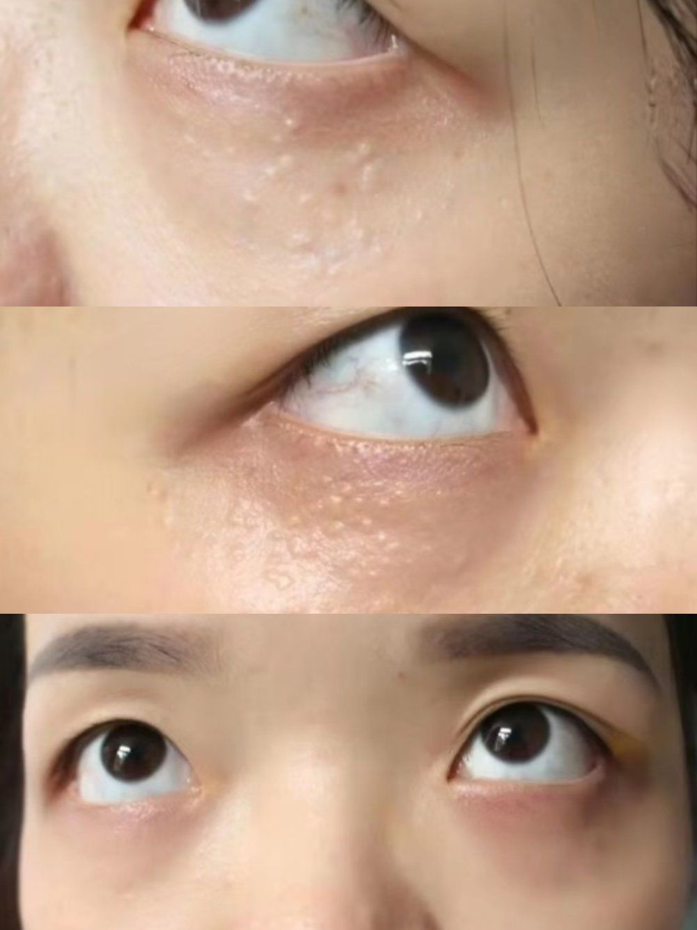 汗管瘤 也叫眼部结石