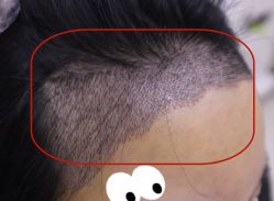 -大麦微针植发全国连锁