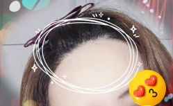 -大麦微针植发全国连锁