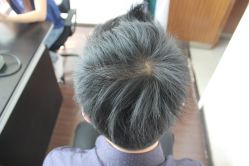 点击看大图 -大麦微针植发丨全国连锁