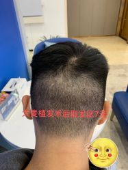 -大麦微针植发全国连锁