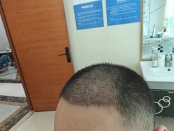 -碧莲盛·不剃发植发