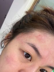 点击看大图 体验后-苗医生0感祛痘连锁