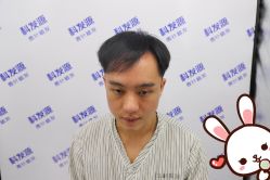 点击看大图 -大麦微针植发丨全国连锁