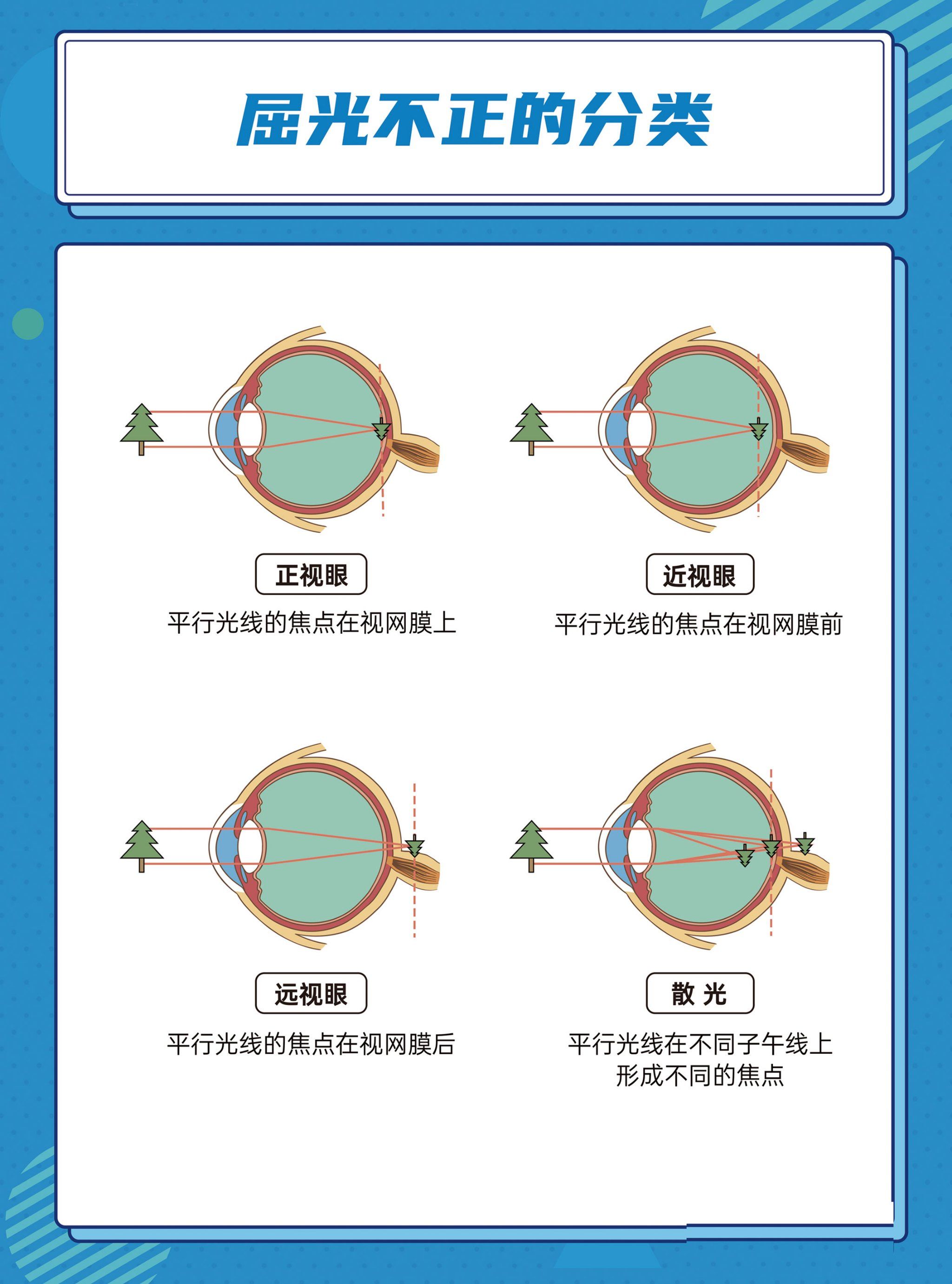 它包括远视,近视及散光