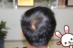 点击看大图 -大麦微针植发丨全国连锁