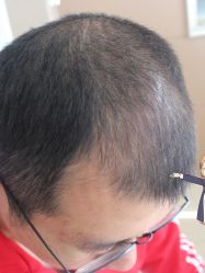 -大麦微针植发丨全国连锁