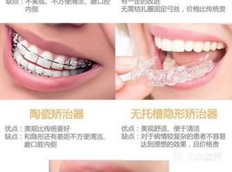 牙套怎么选择？看这篇就够了