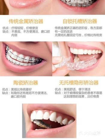 牙套怎么选择？看这篇就够了