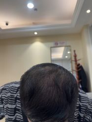 -碧莲盛·不剃发植发