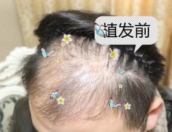 -大麦微针植发全国连锁