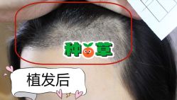 -大麦微针植发全国连锁