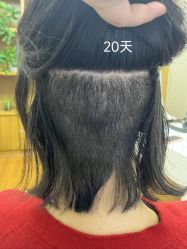 体验后-大麦微针植发全国连锁