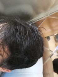 -碧莲盛·不剃发植发