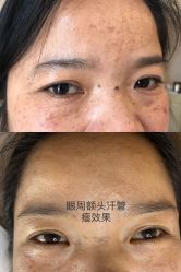-爱莎扁平疣·汗管瘤·斑痣中心
