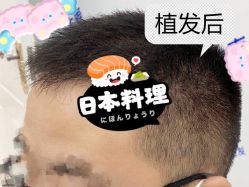 -大麦微针植发全国连锁