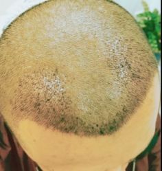 -大麦微针植发丨全国连锁
