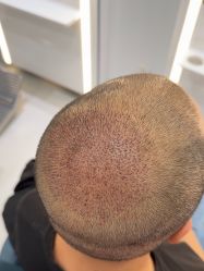 -大麦微针植发全国连锁