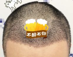 -大麦微针植发全国连锁