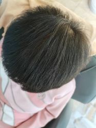 -大麦微针植发丨全国连锁