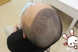 -大麦微针植发丨全国连锁