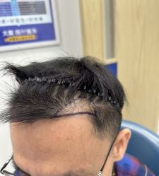 -大麦微针植发全国连锁