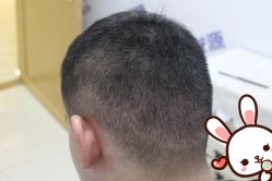 点击看大图 -大麦微针植发丨全国连锁