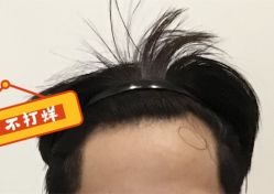 -大麦微针植发全国连锁