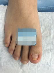 点击看大图 甲沟炎发炎起来要人命,不好走路,现在康复中好多了-派恩宜灰指甲鸡眼嵌甲手足癣