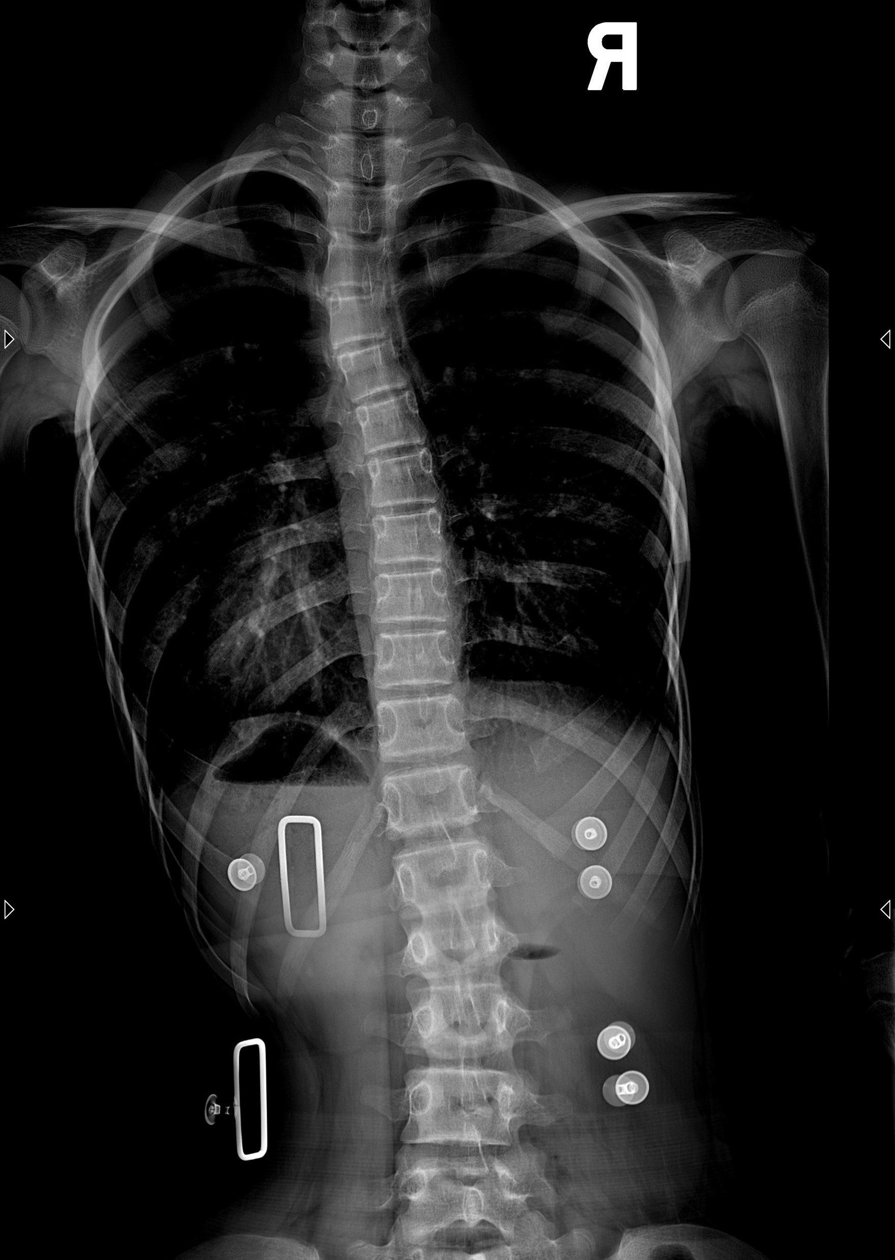 脊柱侧弯的矫正支具