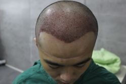 点击看大图 -大麦微针植发丨全国连锁