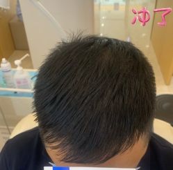 -大麦微针植发丨全国连锁